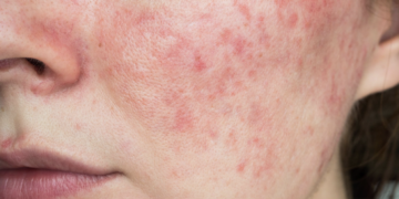 Rosacea