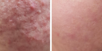 Acne 16 week Skin Treatment Program